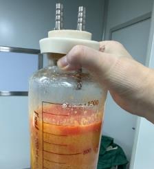 上海水动力吸脂手术要做多久？